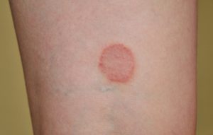 ringworm zoonotic diseases